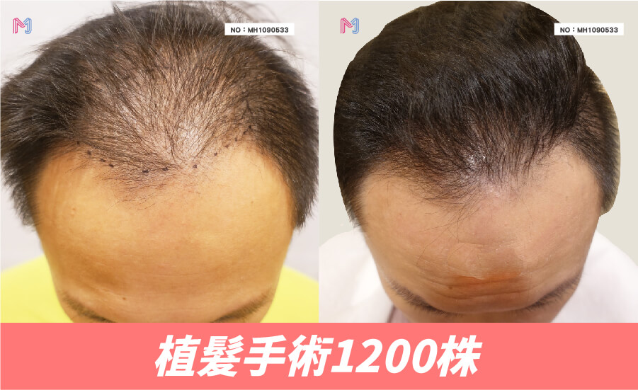 明錦FUE植髮手術1200株