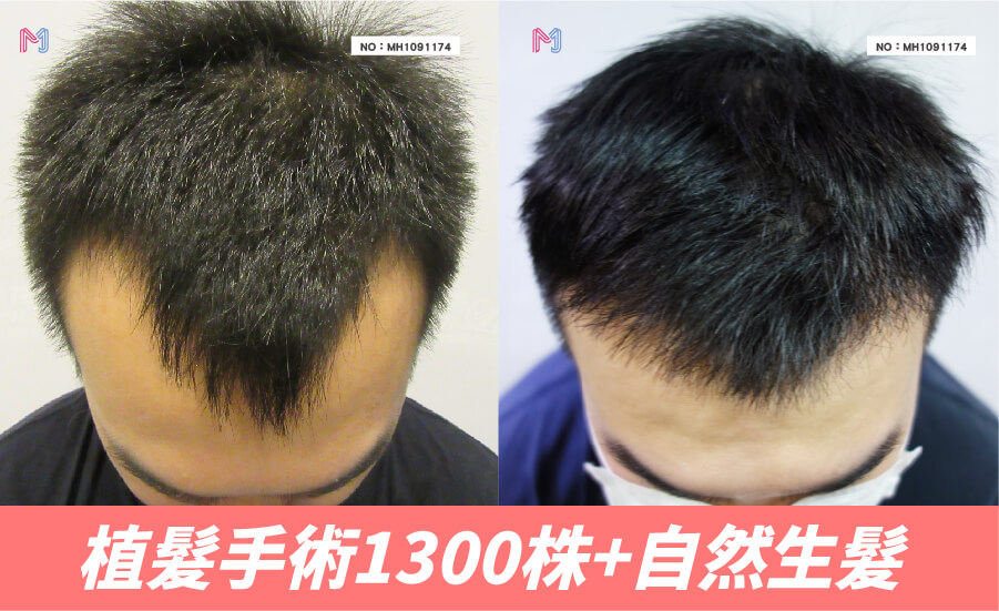 明錦FUE植髮手術1300株+自然生髮案例