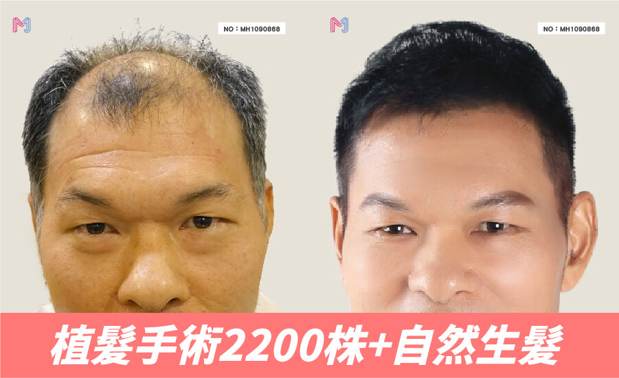 明錦FUE植髮手術2200株+自然生髮案例