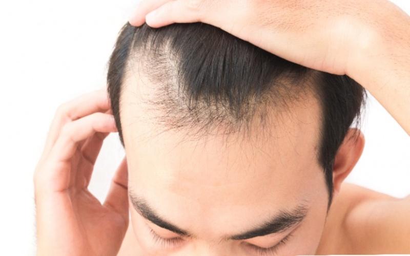 M型禿怎麼辦？有救嗎？了解4大成因與治療方式，拯救髮際線